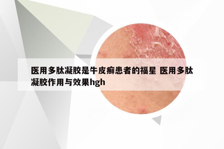 医用多肽凝胶是牛皮癣患者的福星 医用多肽凝胶作用与效果hgh