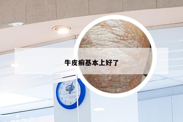 牛皮癣基本上好了