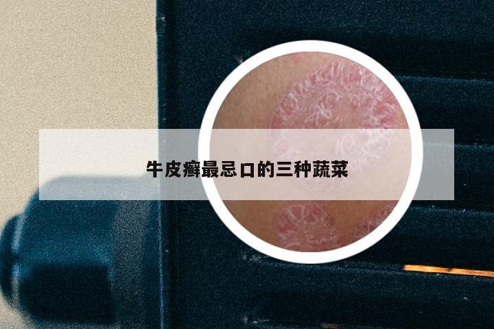 牛皮癣最忌口的三种蔬菜