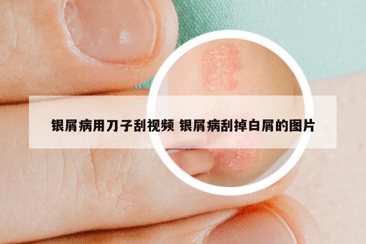 银屑病用刀子刮视频 银屑病刮掉白屑的图片