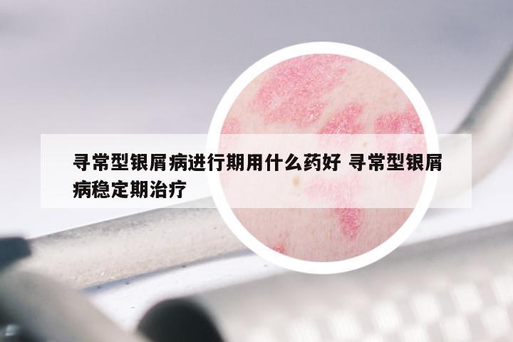 寻常型银屑病进行期用什么药好 寻常型银屑病稳定期治疗