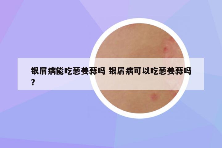 银屑病能吃葱姜蒜吗 银屑病可以吃葱姜蒜吗?