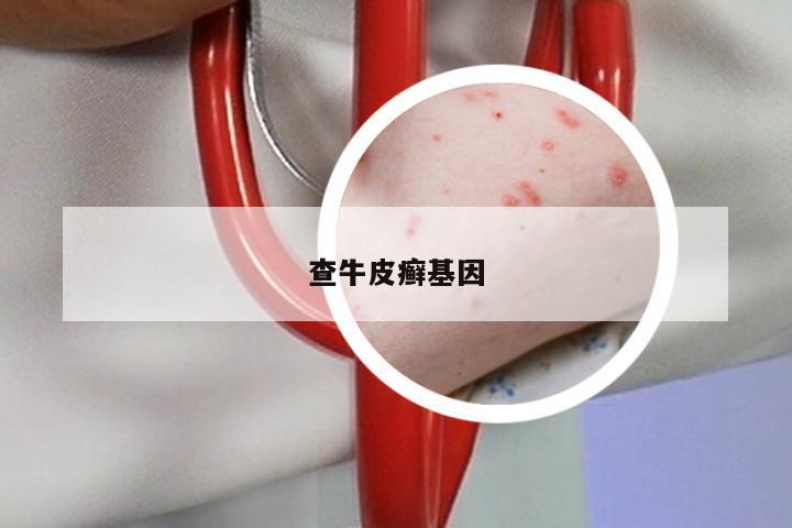 查牛皮癣基因
