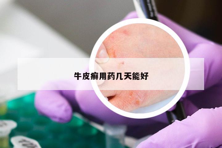 牛皮癣用药几天能好