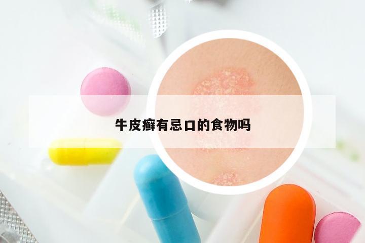 牛皮癣有忌口的食物吗