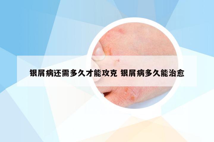 银屑病还需多久才能攻克 银屑病多久能治愈