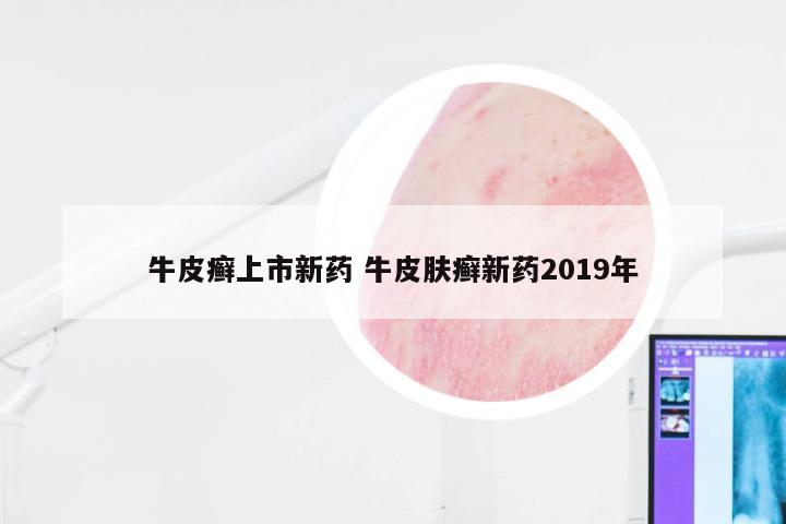 牛皮癣上市新药 牛皮肤癣新药2019年