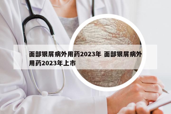 面部银屑病外用药2023年 面部银屑病外用药2023年上市