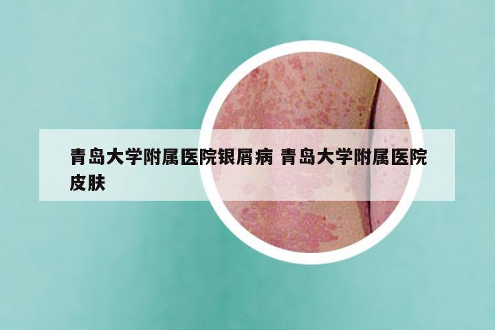 青岛大学附属医院银屑病 青岛大学附属医院皮肤