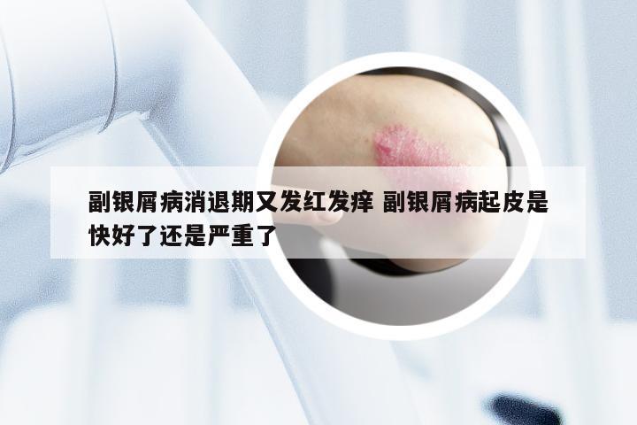 副银屑病消退期又发红发痒 副银屑病起皮是快好了还是严重了