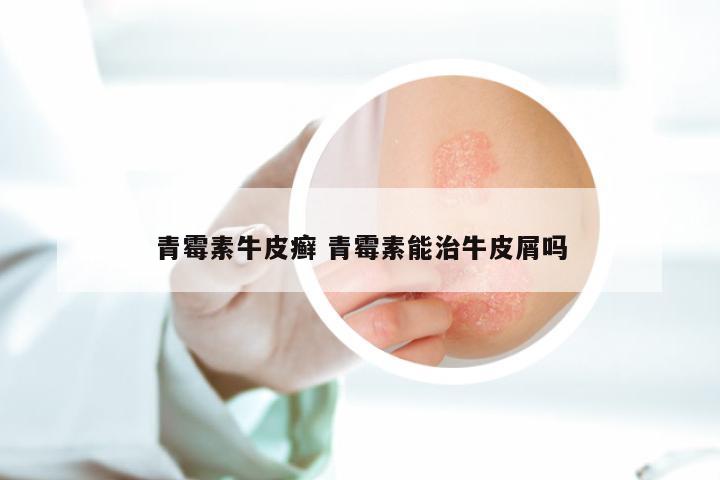 青霉素牛皮癣 青霉素能治牛皮屑吗