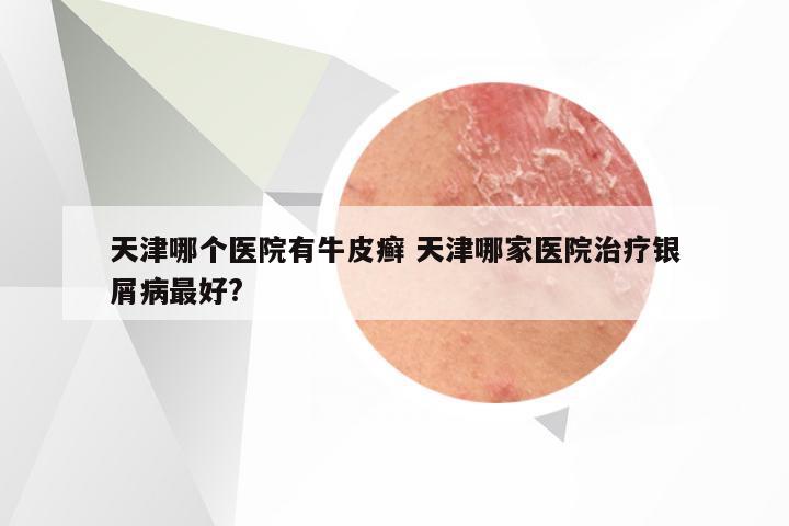 天津哪个医院有牛皮癣 天津哪家医院治疗银屑病最好?
