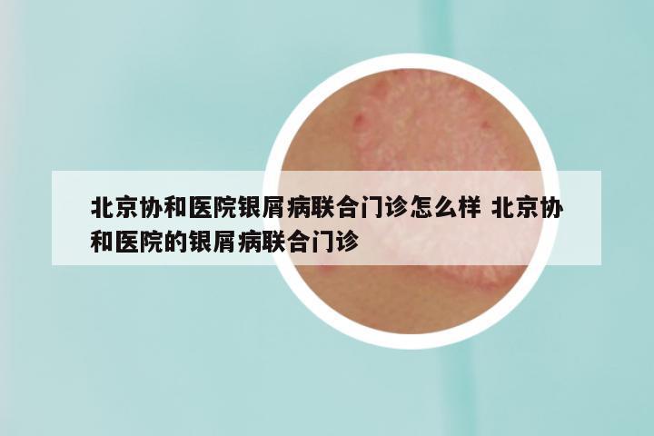 北京协和医院银屑病联合门诊怎么样 北京协和医院的银屑病联合门诊