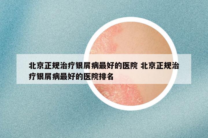 北京正规治疗银屑病最好的医院 北京正规治疗银屑病最好的医院排名