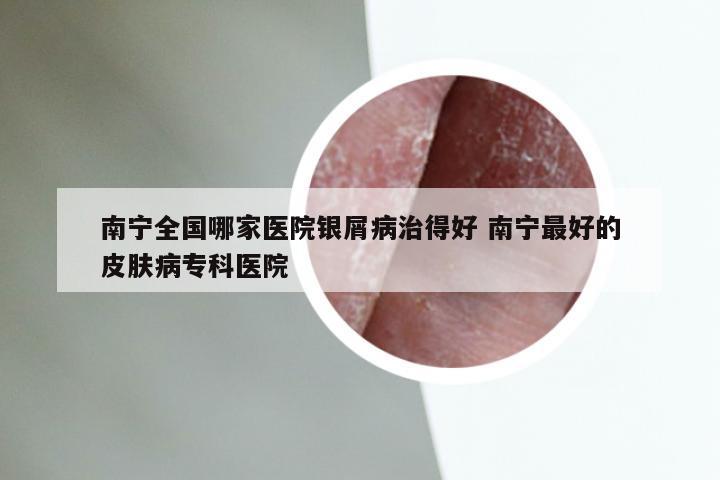 南宁全国哪家医院银屑病治得好 南宁最好的皮肤病专科医院