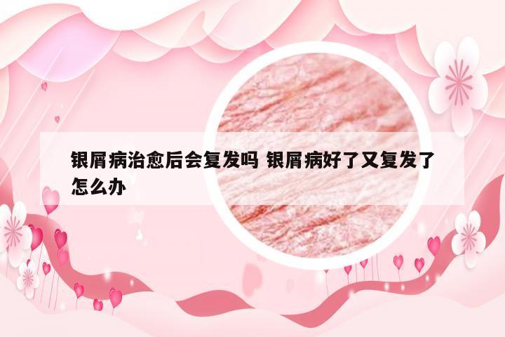 银屑病治愈后会复发吗 银屑病好了又复发了怎么办