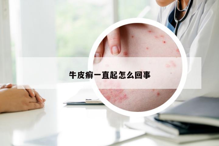 牛皮癣一直起怎么回事