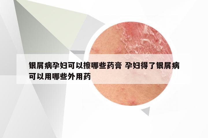 银屑病孕妇可以擦哪些药膏 孕妇得了银屑病可以用哪些外用药