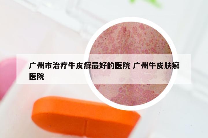 广州市治疗牛皮癣最好的医院 广州牛皮肤癣医院