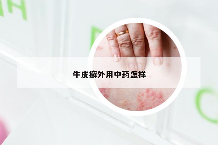 牛皮癣外用中药怎样