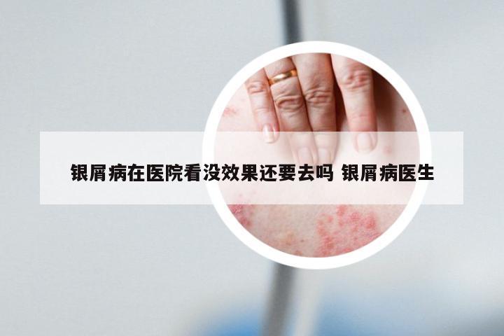 银屑病在医院看没效果还要去吗 银屑病医生