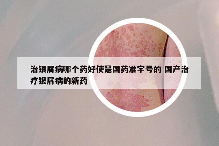 治银屑病哪个药好使是国药准字号的 国产治疗银屑病的新药