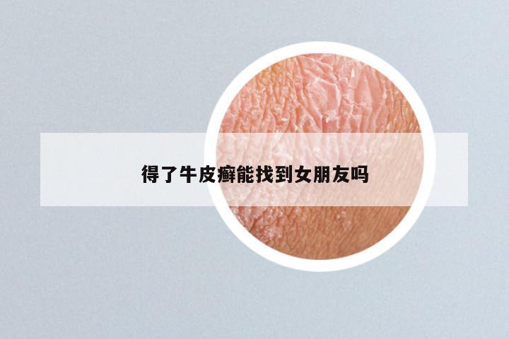 得了牛皮癣能找到女朋友吗