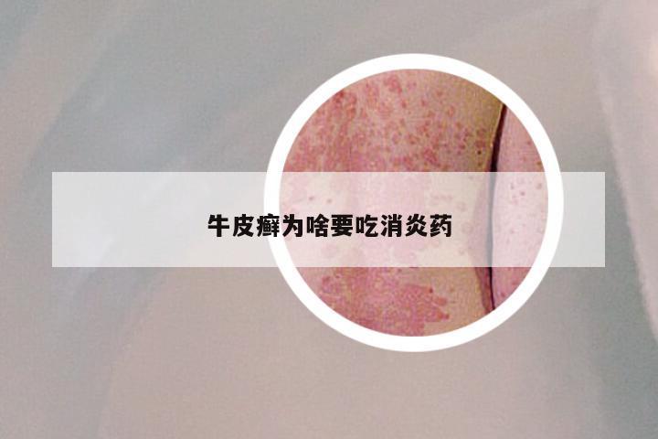 牛皮癣为啥要吃消炎药