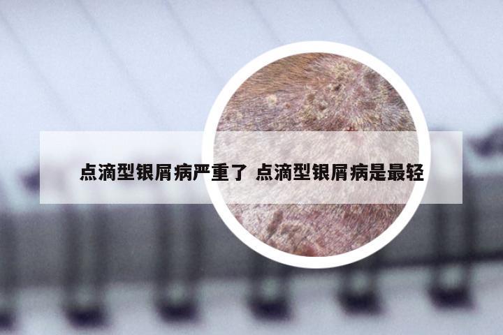 点滴型银屑病严重了 点滴型银屑病是最轻