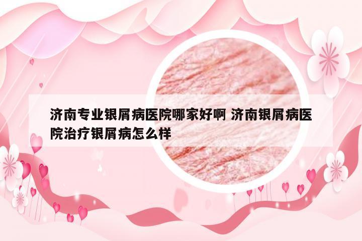 济南专业银屑病医院哪家好啊 济南银屑病医院治疗银屑病怎么样