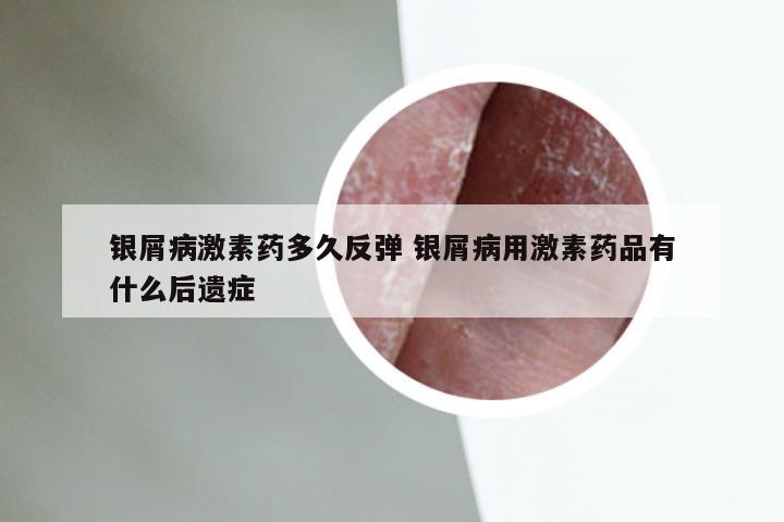 银屑病激素药多久反弹 银屑病用激素药品有什么后遗症