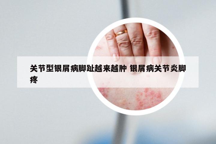 关节型银屑病脚趾越来越肿 银屑病关节炎脚疼