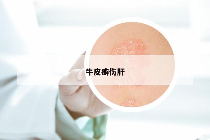牛皮癣伤肝