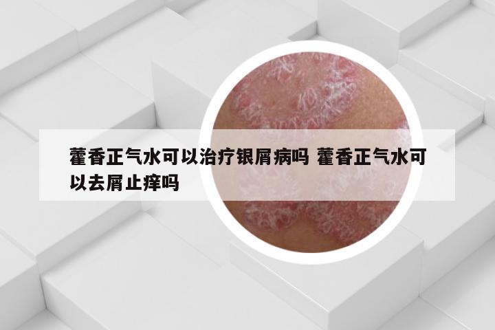 藿香正气水可以治疗银屑病吗 藿香正气水可以去屑止痒吗