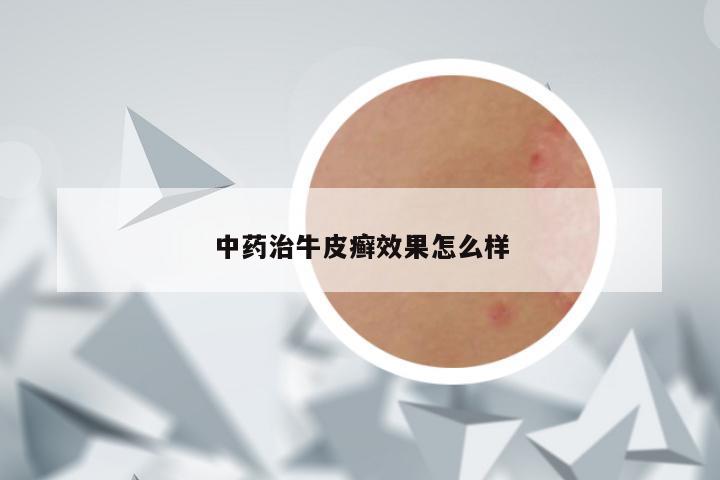 中药治牛皮癣效果怎么样