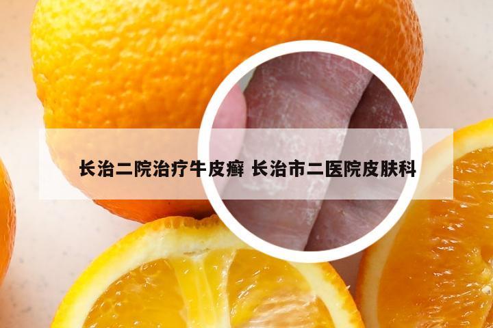 长治二院治疗牛皮癣 长治市二医院皮肤科