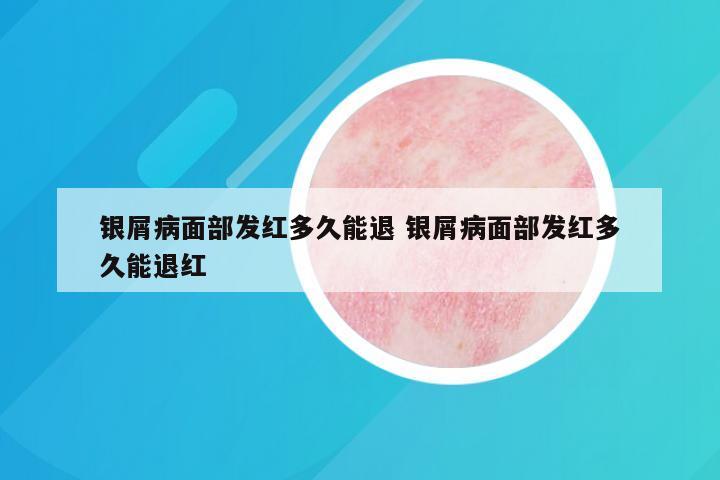 银屑病面部发红多久能退 银屑病面部发红多久能退红