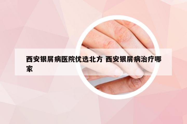 西安银屑病医院优选北方 西安银屑病治疗哪家