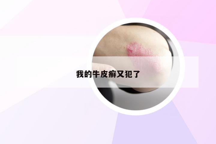 我的牛皮癣又犯了