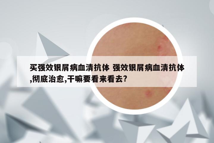 买强效银屑病血清抗体 强效银屑病血清抗体,彻底治愈,干嘛要看来看去?
