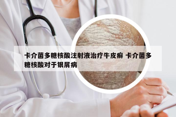 卡介菌多糖核酸注射液治疗牛皮癣 卡介菌多糖核酸对于银屑病