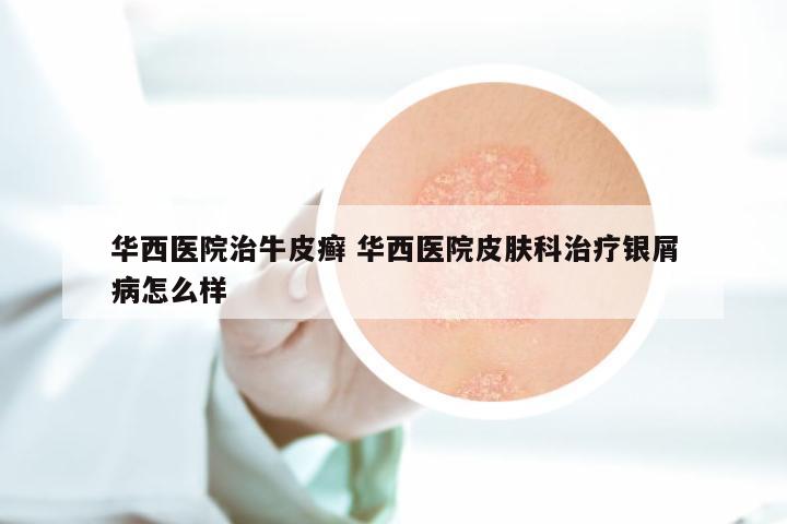 华西医院治牛皮癣 华西医院皮肤科治疗银屑病怎么样