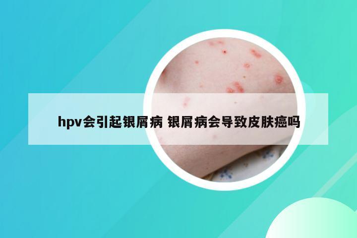hpv会引起银屑病 银屑病会导致皮肤癌吗