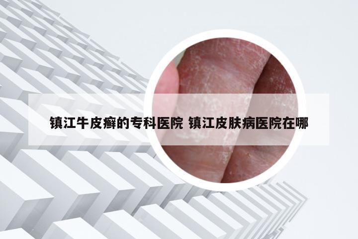 镇江牛皮癣的专科医院 镇江皮肤病医院在哪