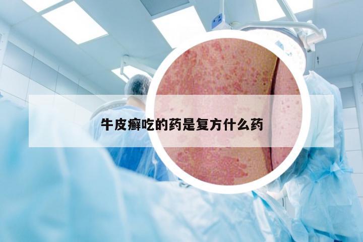 牛皮癣吃的药是复方什么药