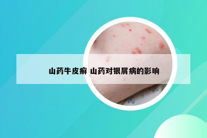 山药牛皮癣 山药对银屑病的影响