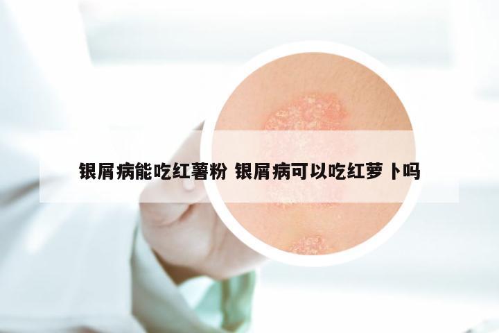 银屑病能吃红薯粉 银屑病可以吃红萝卜吗