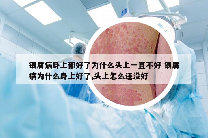 银屑病身上都好了为什么头上一直不好 银屑病为什么身上好了,头上怎么还没好