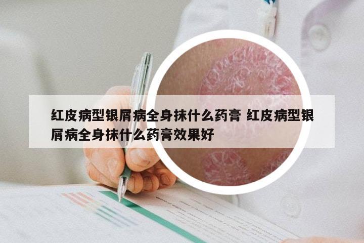 红皮病型银屑病全身抹什么药膏 红皮病型银屑病全身抹什么药膏效果好