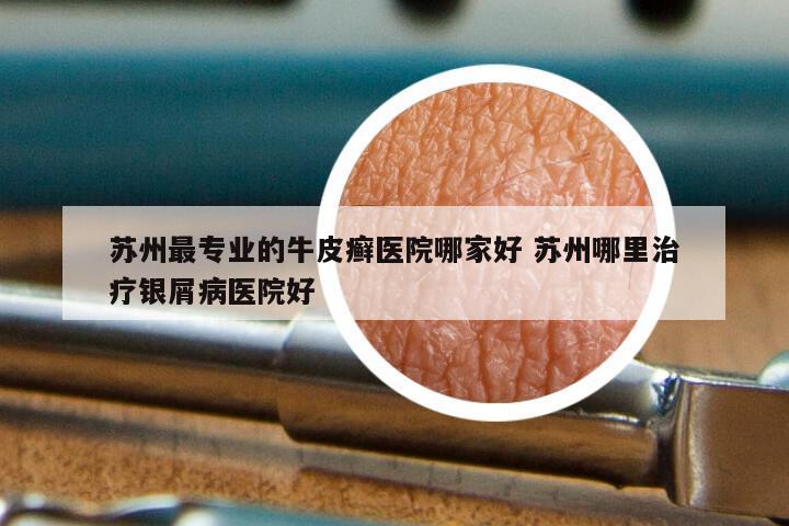 苏州最专业的牛皮癣医院哪家好 苏州哪里治疗银屑病医院好